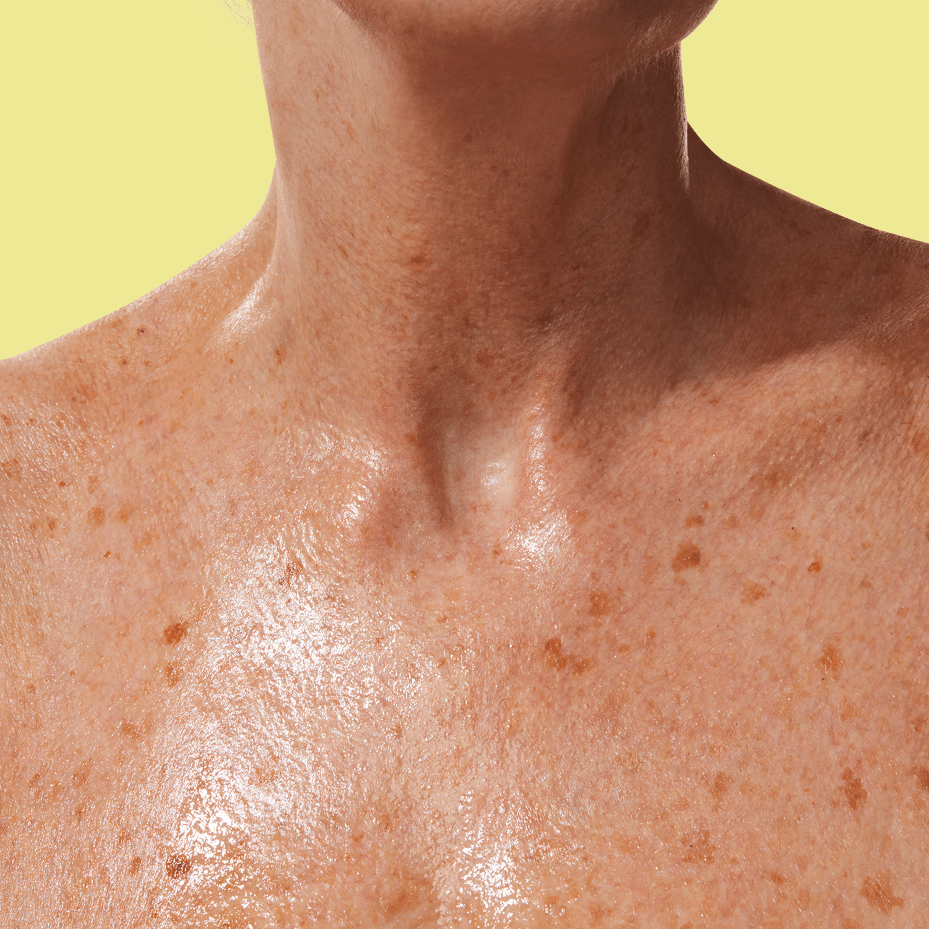 A closeup of a pigmented shoulder and upper body.