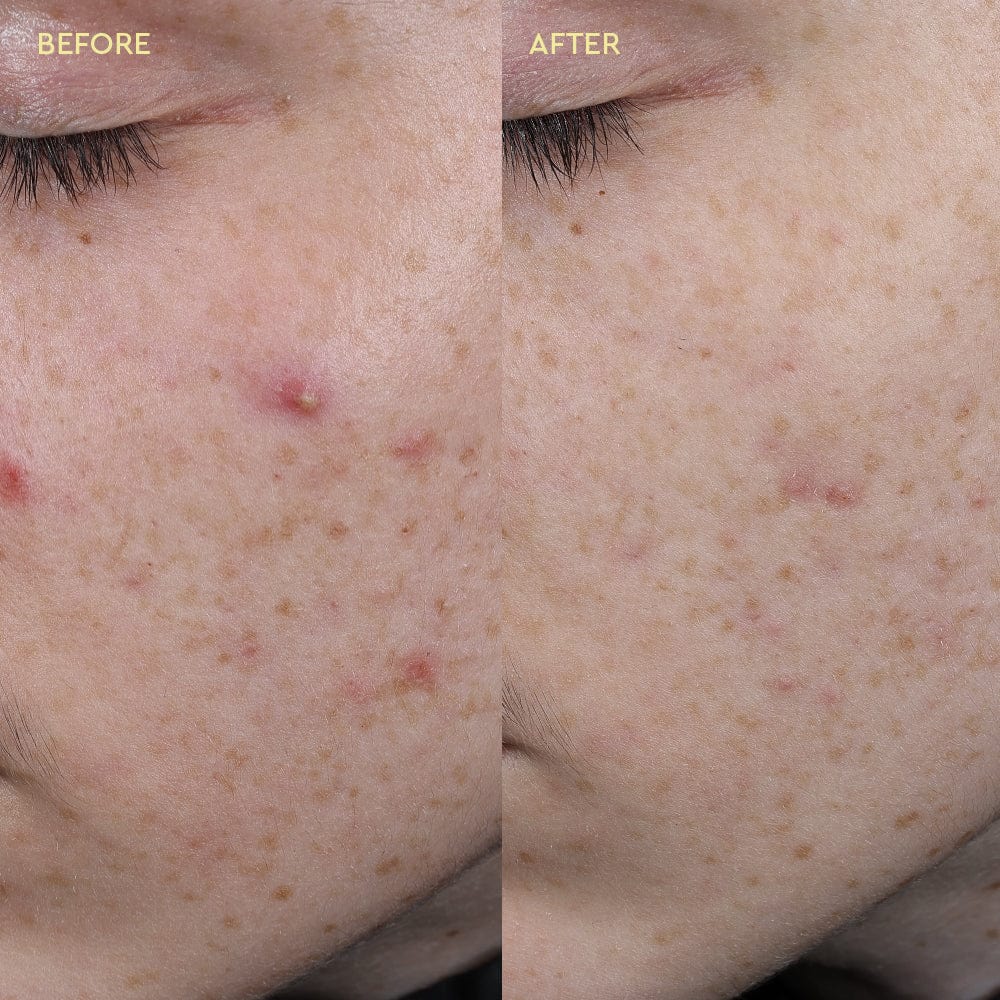 Blemish Clearing Paste