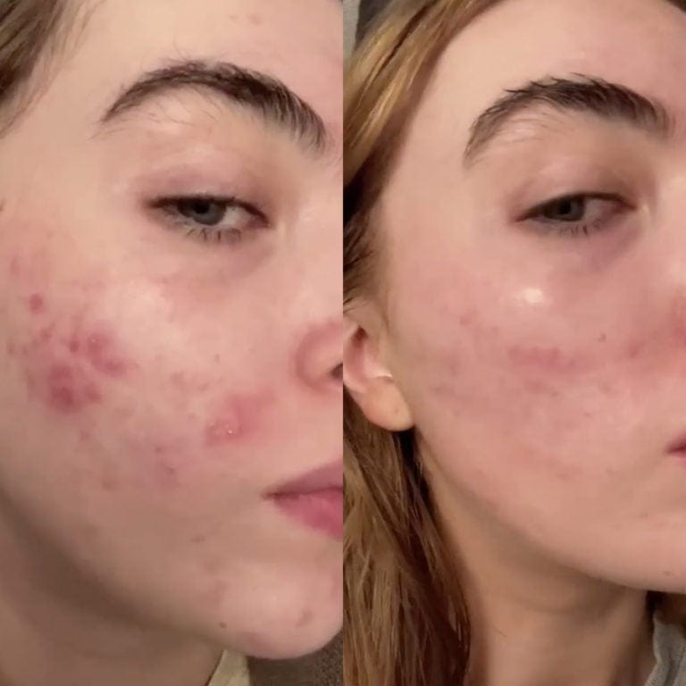 Before after photos of a girl with heavy acne on cheeks on one and clearer skin on the other.