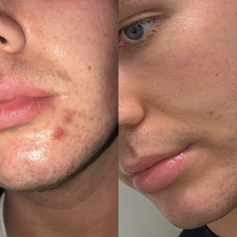Before after photos of a boy with acne on chin on one and clear skin on the other.