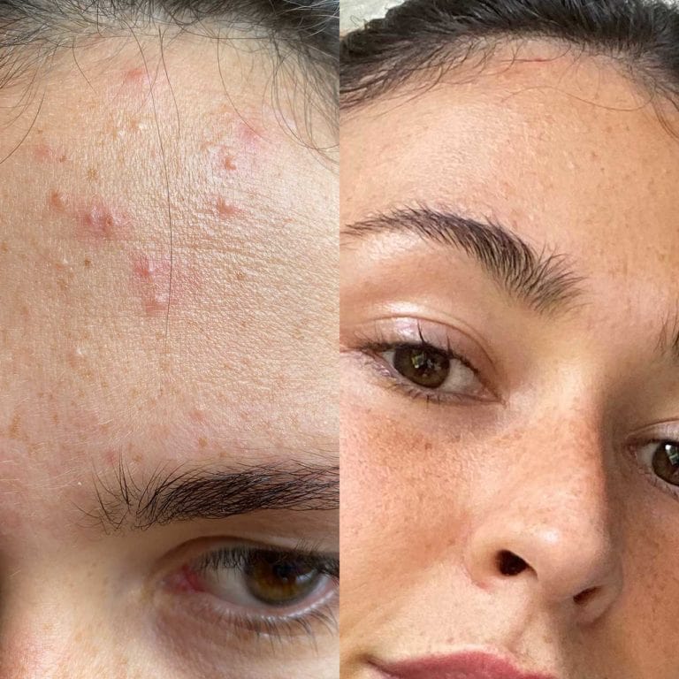 Before after photos of a girl with acne on forehead on one and clear skin with freckles on the other.
