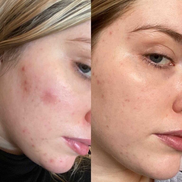 Before after photos of a girl with acne on cheeks on one and clearer skin on the other.