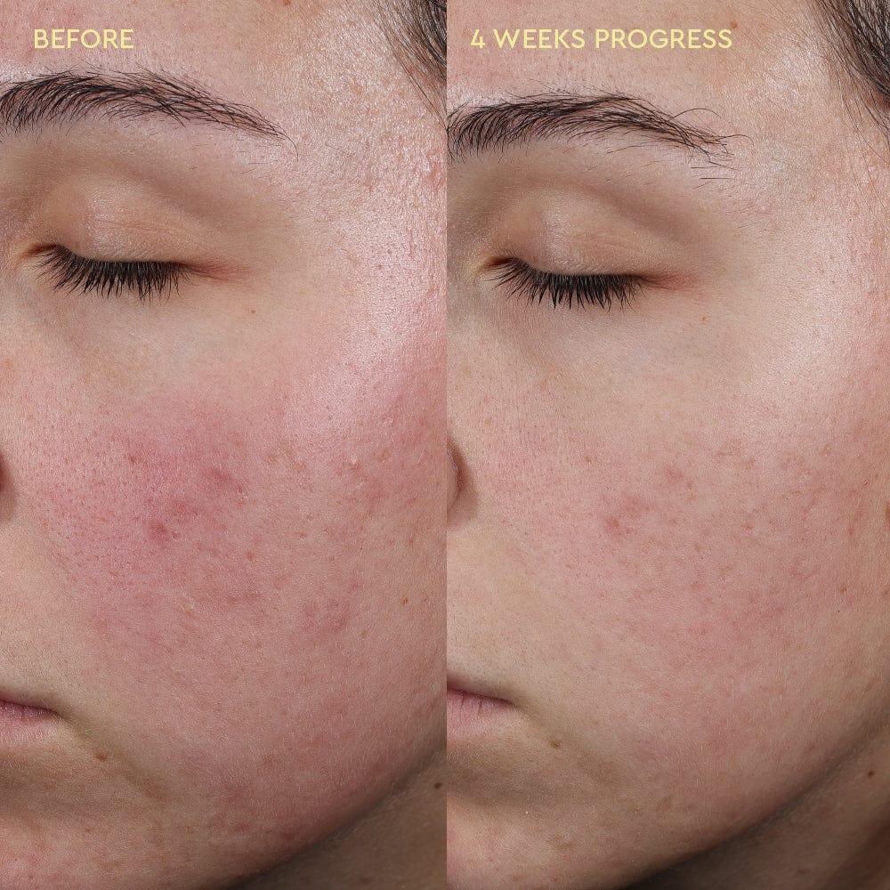 Before and after comparison of a person's face with acne, showing 4 weeks of progress.
