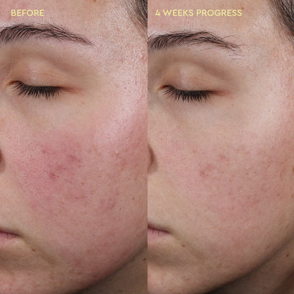 Before and after comparison of a person's face with acne, showing 4 weeks of progress.