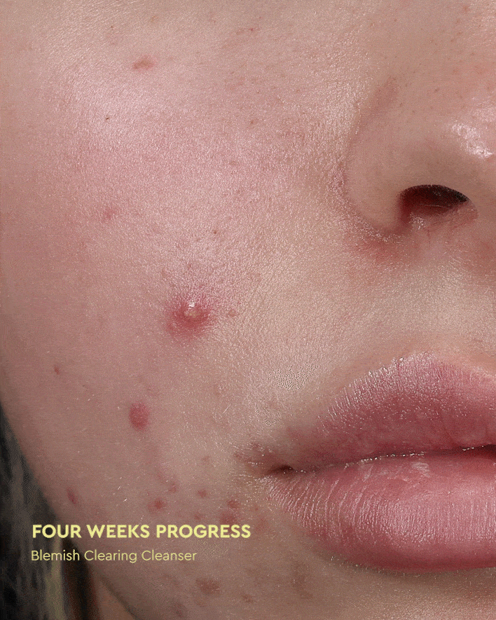 Byoma Blemish – BYOMA UK