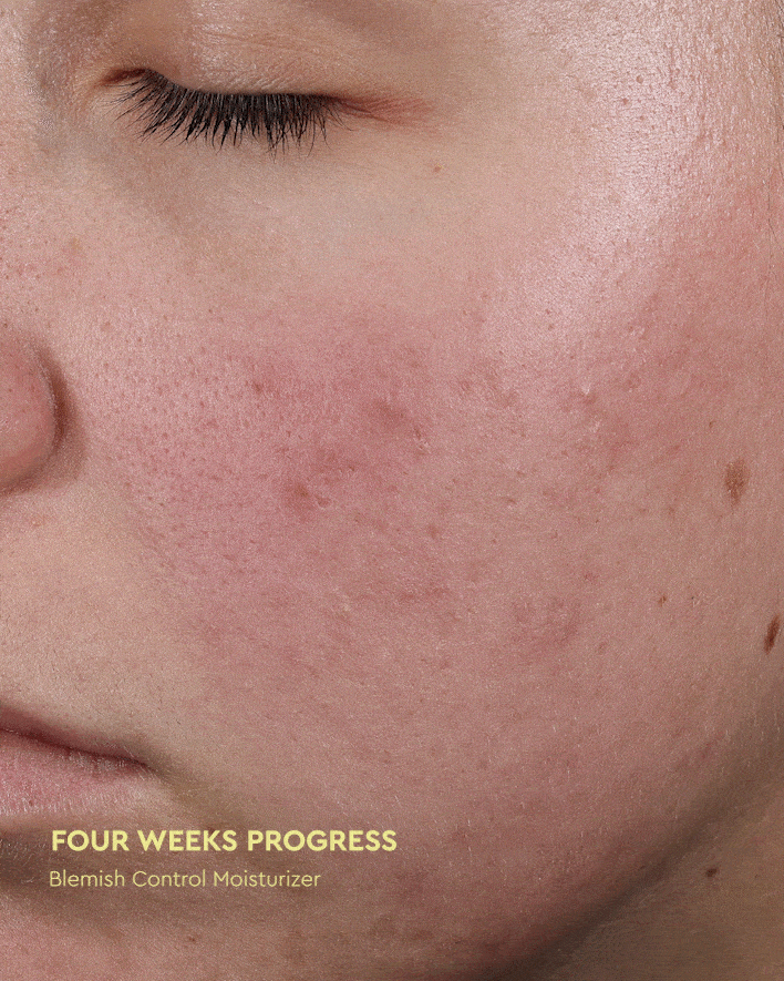 Byoma Blemish – BYOMA UK