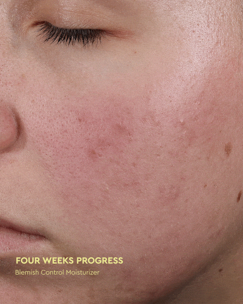 Byoma Blemish – BYOMA UK